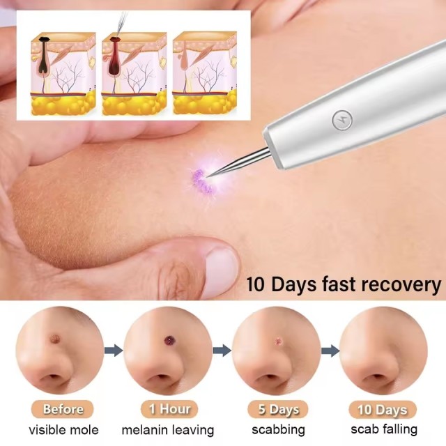 Dark Spot Mole Wart Remover Pen Skin Tag Remover Laser Plasma Pen for Skin Tag Remover