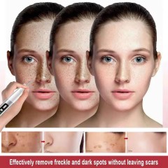 Dark Spot Mole Wart Remover Pen Skin Tag Remover Laser Plasma Pen for Skin Tag Remover