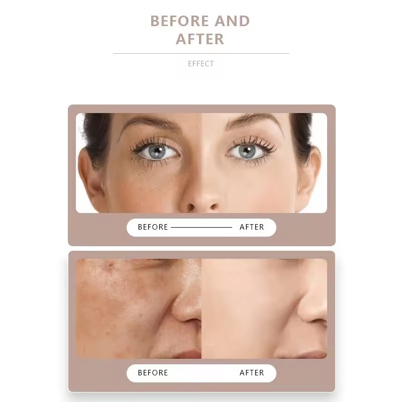 Face Skin and Mole Tag Pen Face Spot Removal Artifact Laser Beauty Pen