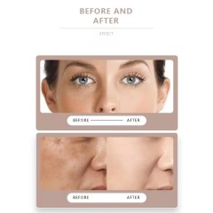 Face Skin and Mole Tag Pen Face Spot Removal Artifact Laser Beauty Pen