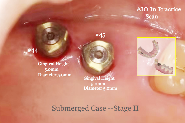 AIO healing scanable abutment