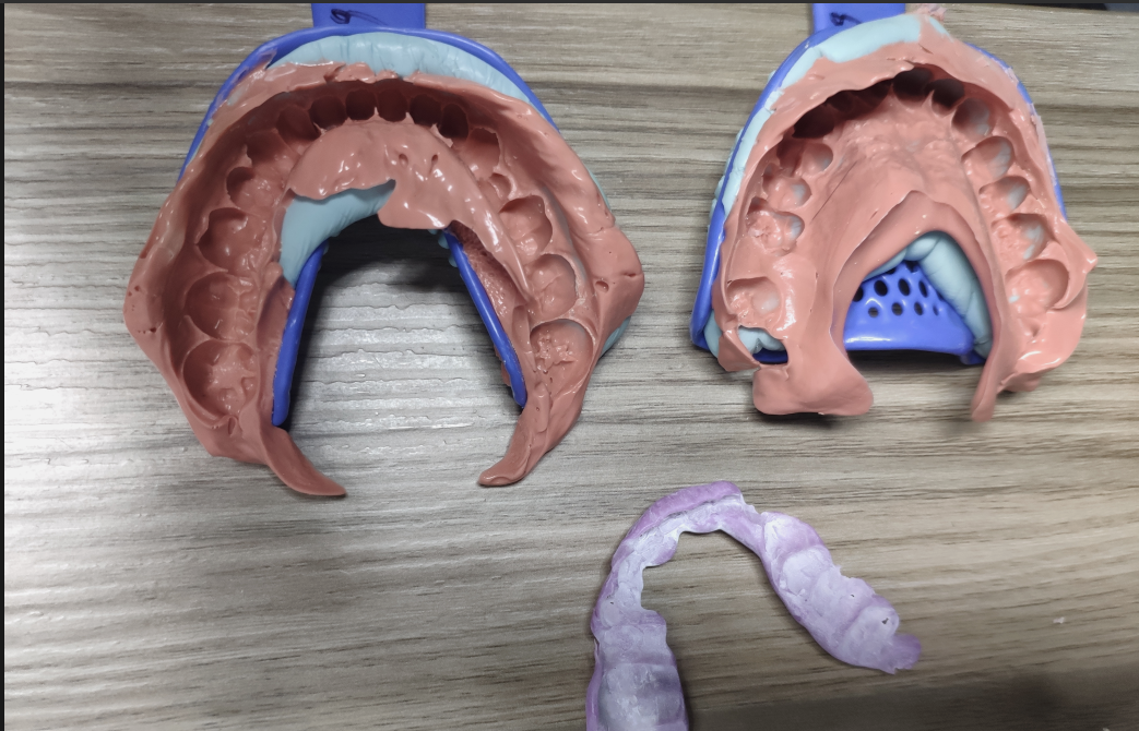 tray impression with AIO abutment
