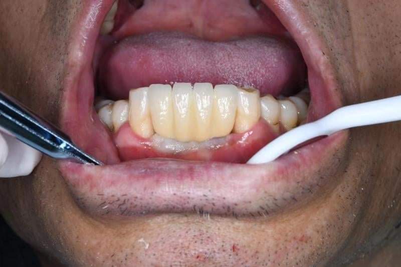 dental restoration from lab