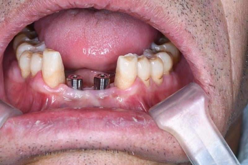 AIO healing abutment