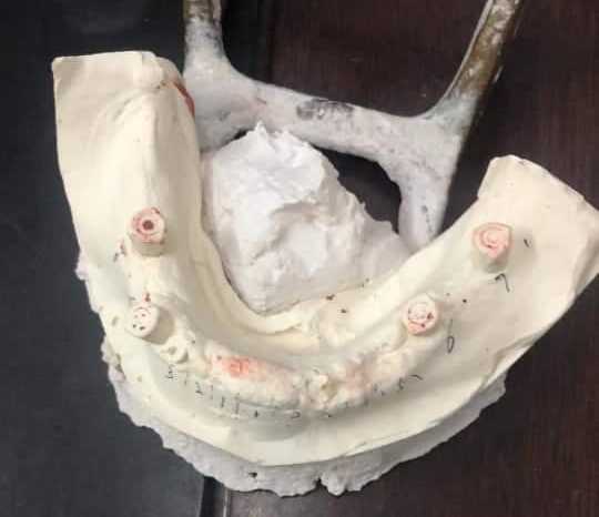 make dental stone model