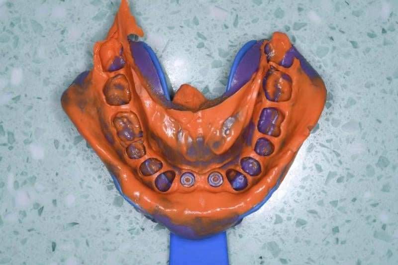 take tray impression with AIO abutment