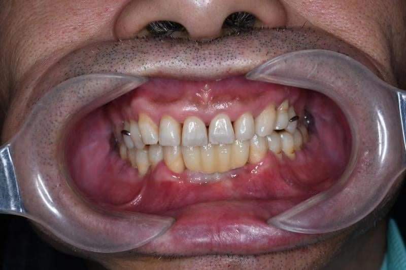 dental restoration for patient