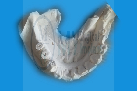 AIO to get impression to make stone model without analog