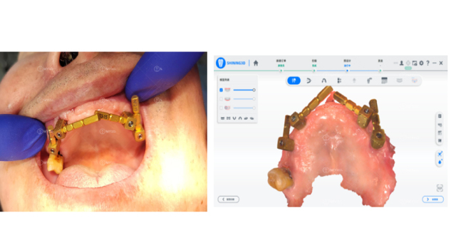 M6 Dental MUA abutment level scanbody for edentulous case to get accurate digital impression