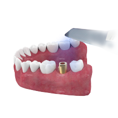Zimmer TSV 3.5 4.5 5.7 compatible dental intra oral scanbody for digital impression made in China