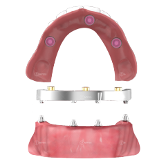 Locator for dental bar