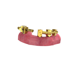 M6 Dental MUA abutment level scanbody for edentulous case to get accurate digital impression