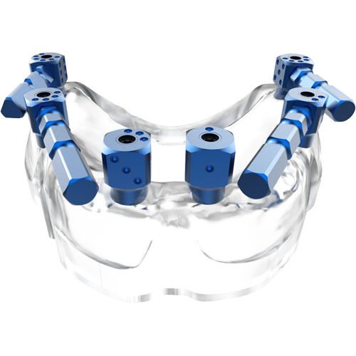 Dentium Zimmer Dental MUA scanbody for full arch case to acquire accurate digital impression