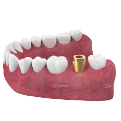 M6 T Plus dental implant scan abutment