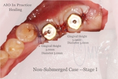 CADCAM digital dentistry AIO: 3 in 1 encoded healing scanbody abutment