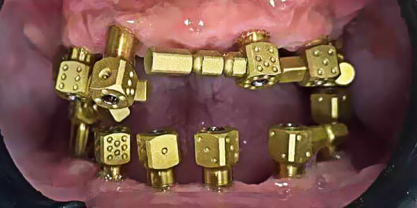 dental full arch scanbody