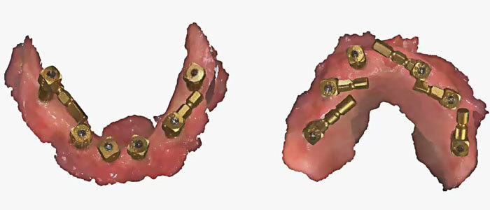 digtial impression of full arch case
