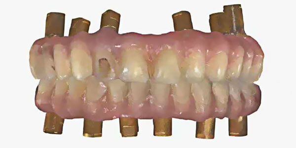 get digital impression from temp restoration