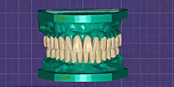 CADCAM permanent restoration for full arch