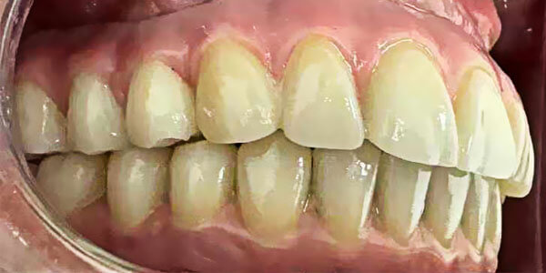 permanent restoration -right