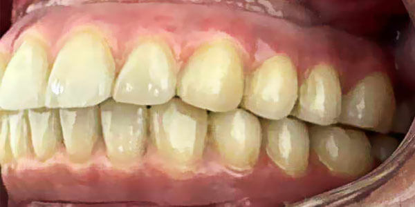 permanent restoration -left