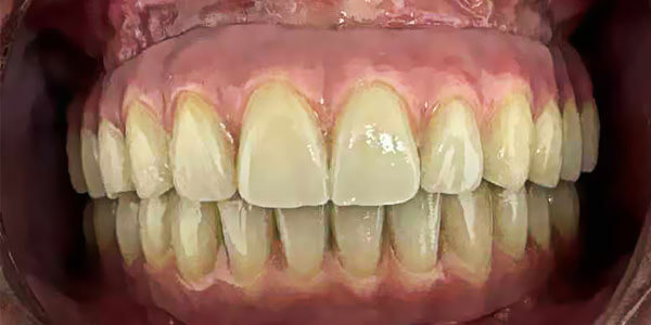 M6 dental full arch case