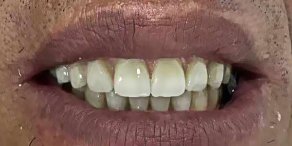 M6 dental full arch case 2