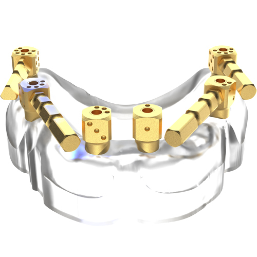 M6 All-on-X Scanning Kit for Anthogyr MUA | Full-Arch Edentulous Case Solutions