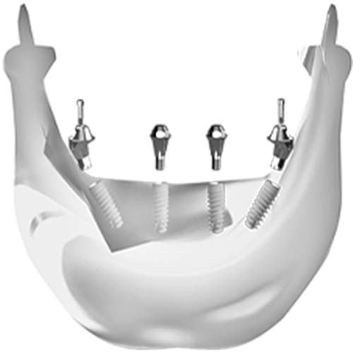 dental all-on-4 implant restoration case