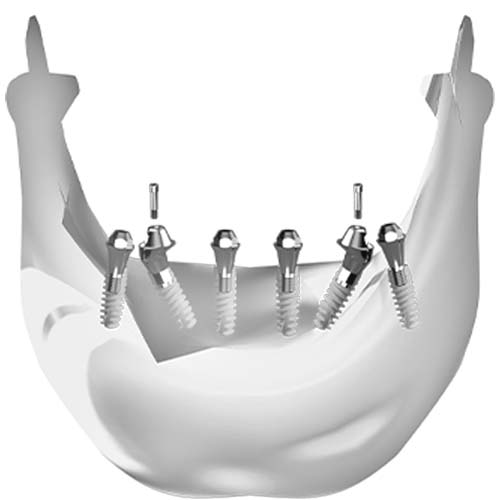 dental all-on-6 implant restoration case