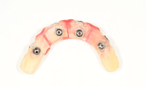 dental temp restoration