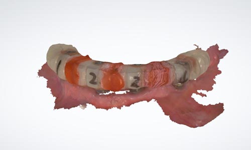 scan temp restoration to confirm occlusion