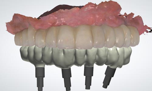CAD design the final restoration
