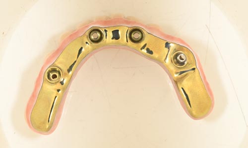 CAM manufacture the final restoration 1