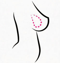 Gel Breasts