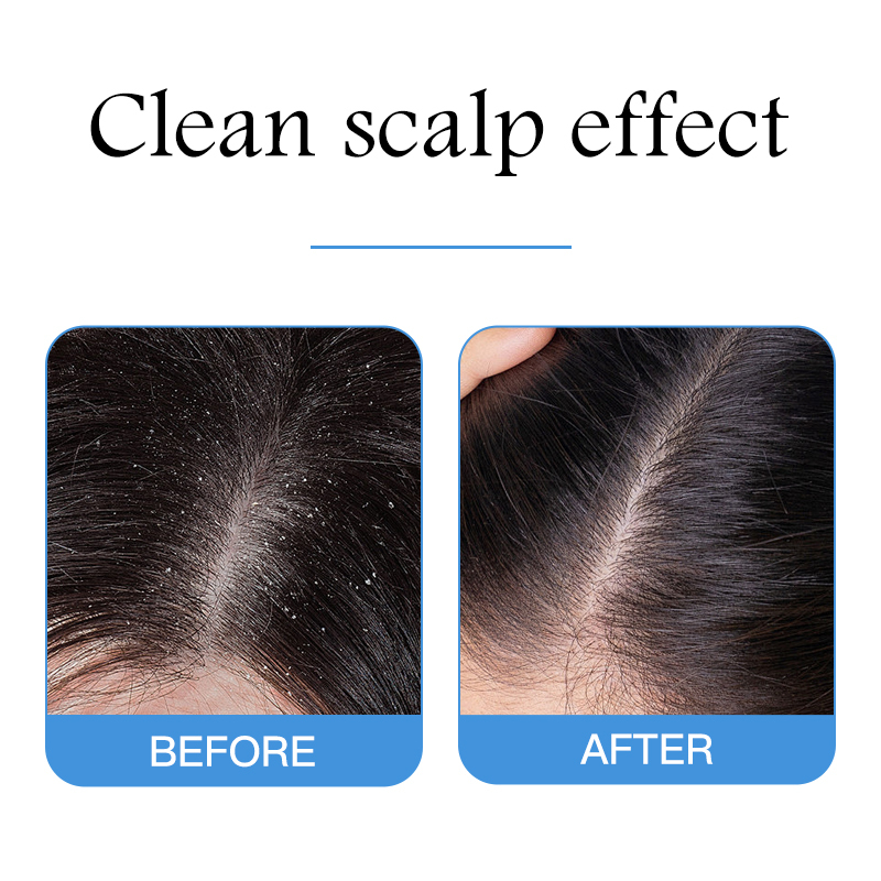 Private Label Custom Brand Cleaning Scalp Moisturizing Hair Anti Dandruff Shampoo Manufacturer in Guangzhou