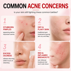 OEM 3H Fast Acting Overnight Drying Balms for Acne Pimple Spot Treatment Calamine Sulfur Anti Acne Solution Serum Private Label