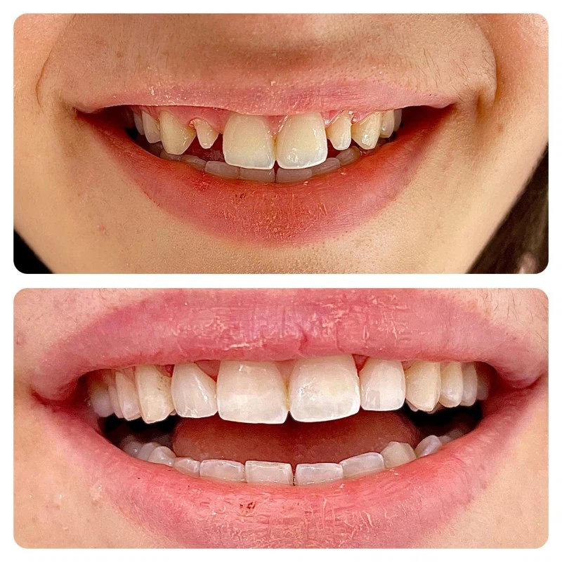 Case study of 4D PRO dental zirconia blocks