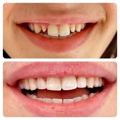 china dental zirconia blocks