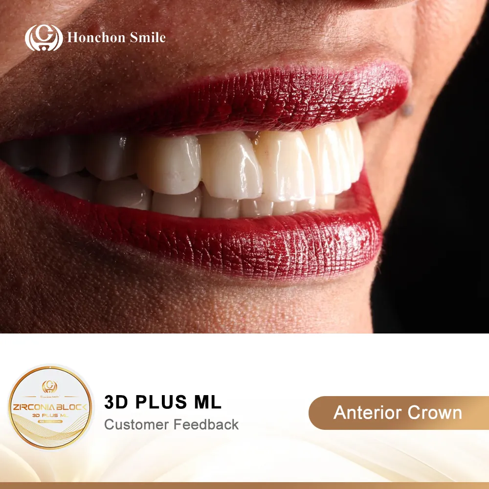 Natural Aesthetics dentures made with HONCHON 3D plus zirconia blocks