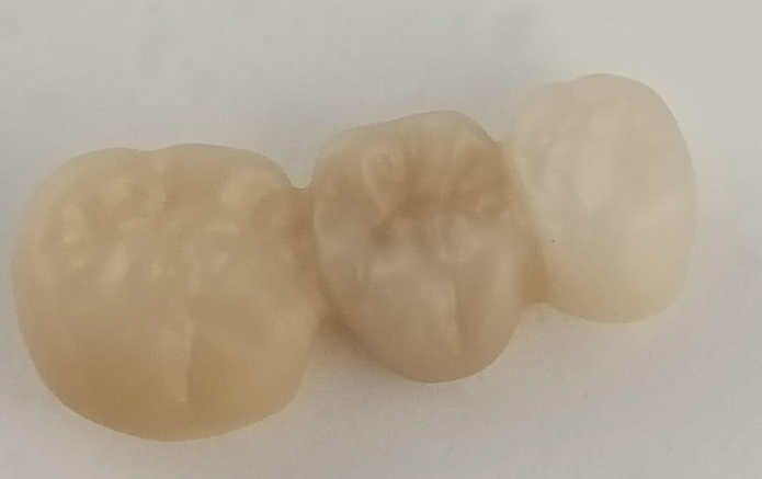 A restoration exhibiting a color difference between the left and right sides after sintering.