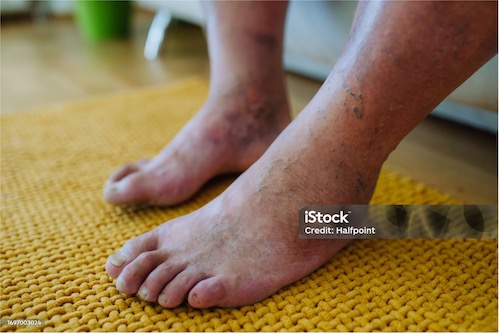 Gemmy Medical Diabetic Foot Guide: Causes, Symptoms, Diagnosis, Treatment and Prevention