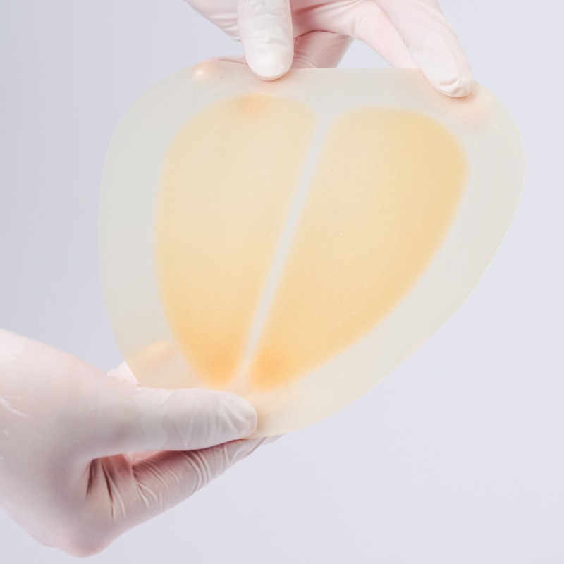 Sacral hydrocolloid dressing, size 15 cm x 18 cm, aesidhve bordered hydrocolloid bandage