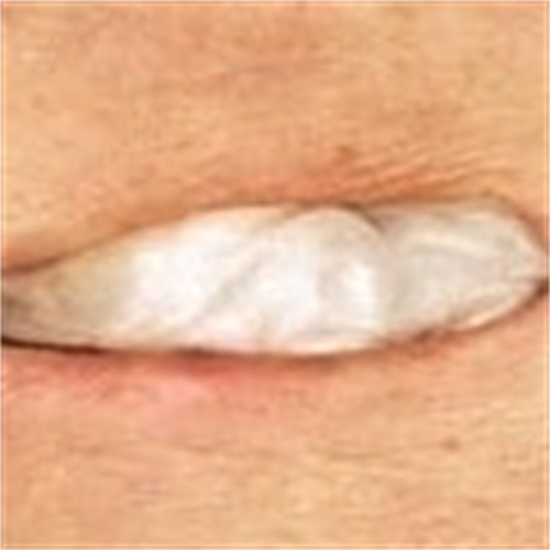 Alginate Dressing In Roll, size 2 cm x 30 cm, Advanced Wound Care Solution, Suitable for cuts and lacerations, Post Surgical Wounds.