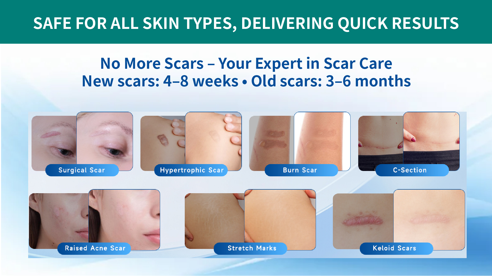 Maximizing Healing Potential: The Power of Silicone Dressing in Scar Treatment