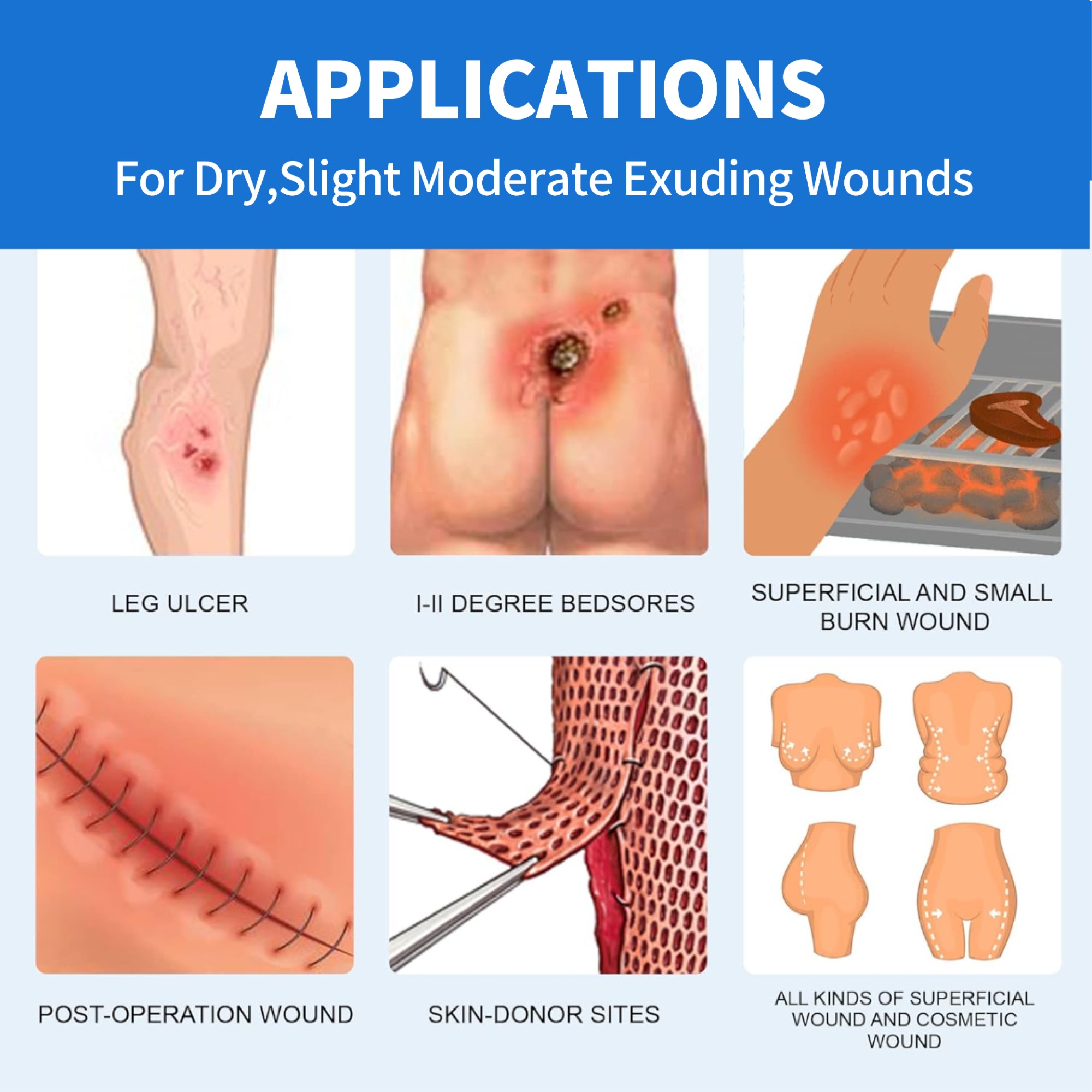 Sacral hydrocolloid dressing, size 15 cm x 18 cm, aesidhve bordered hydrocolloid bandage