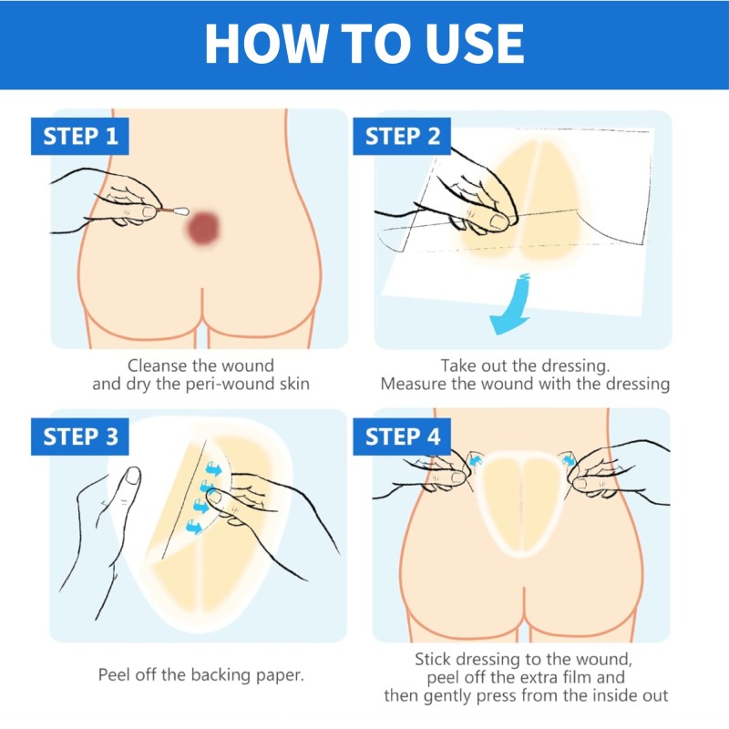 Sacral hydrocolloid dressing, size 15 cm x 18 cm, aesidhve bordered hydrocolloid bandage