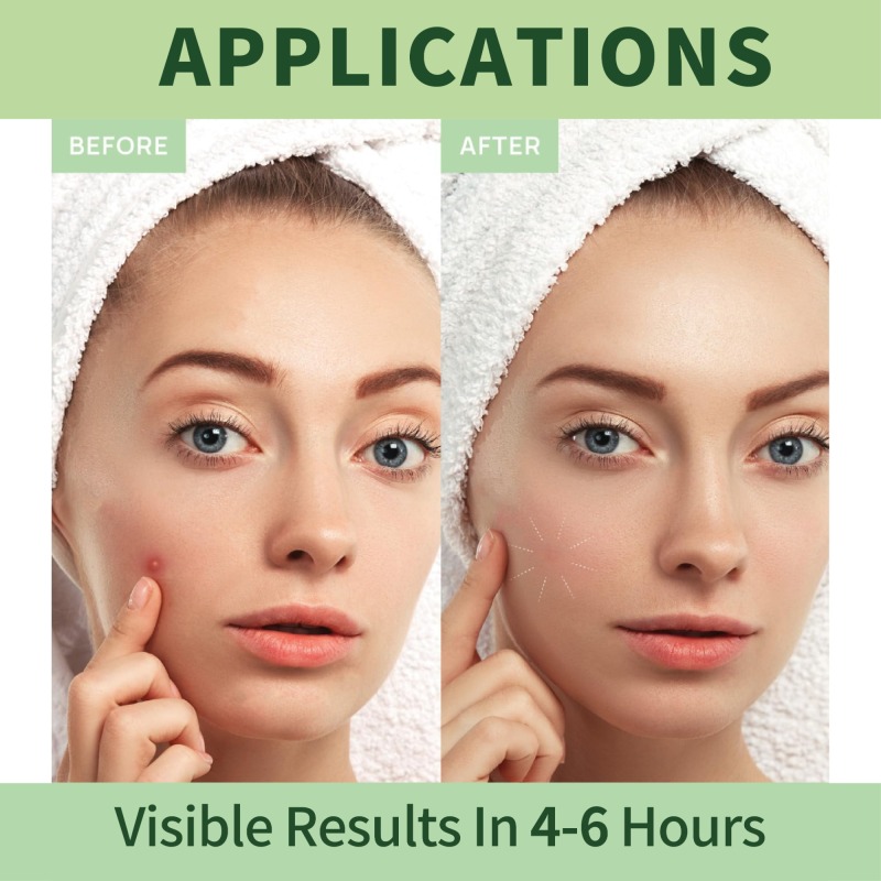 Hydrocolloid Acne Patch round shape 36 pieces