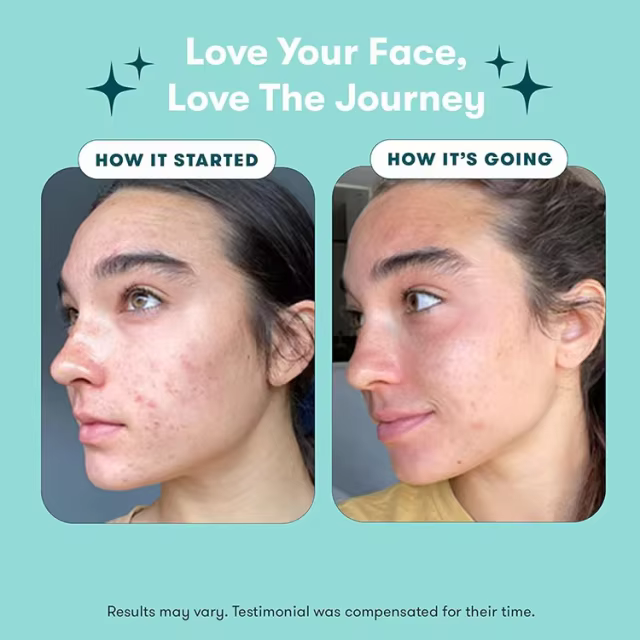 OEM Acne Treatment for Teenage Boys Sensitive Skin Rescue Kit Face Wash,Toner and Moisturizer to Help Clear Pores Reduces Acne