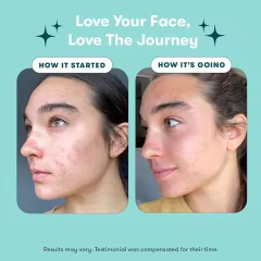 OEM Acne Treatment 3 Steps Skin Care Kit Face Wash, Repairing Acne Spot Treatment for Face and Body, Exfoliating Toner